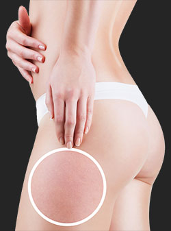 Tratamientos Corporales Madrid: Celulitis